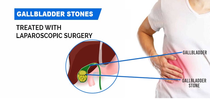 Laparoscopic surgery of gallbladder stone