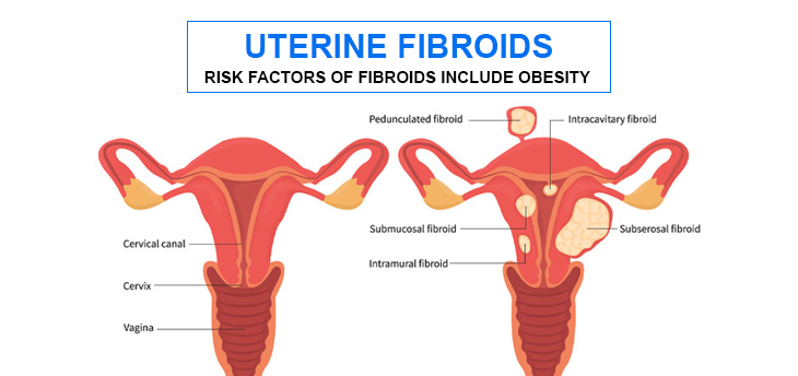 Laparoscopic surgery uterine fibroids
