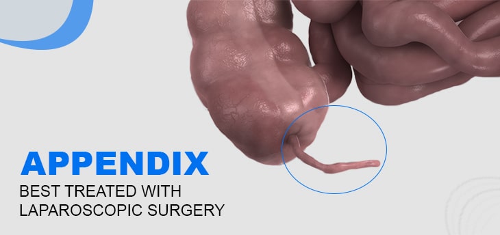 Laparoscopic surgery for appendix